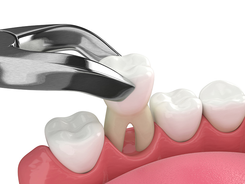 tooth extractions in Brampton