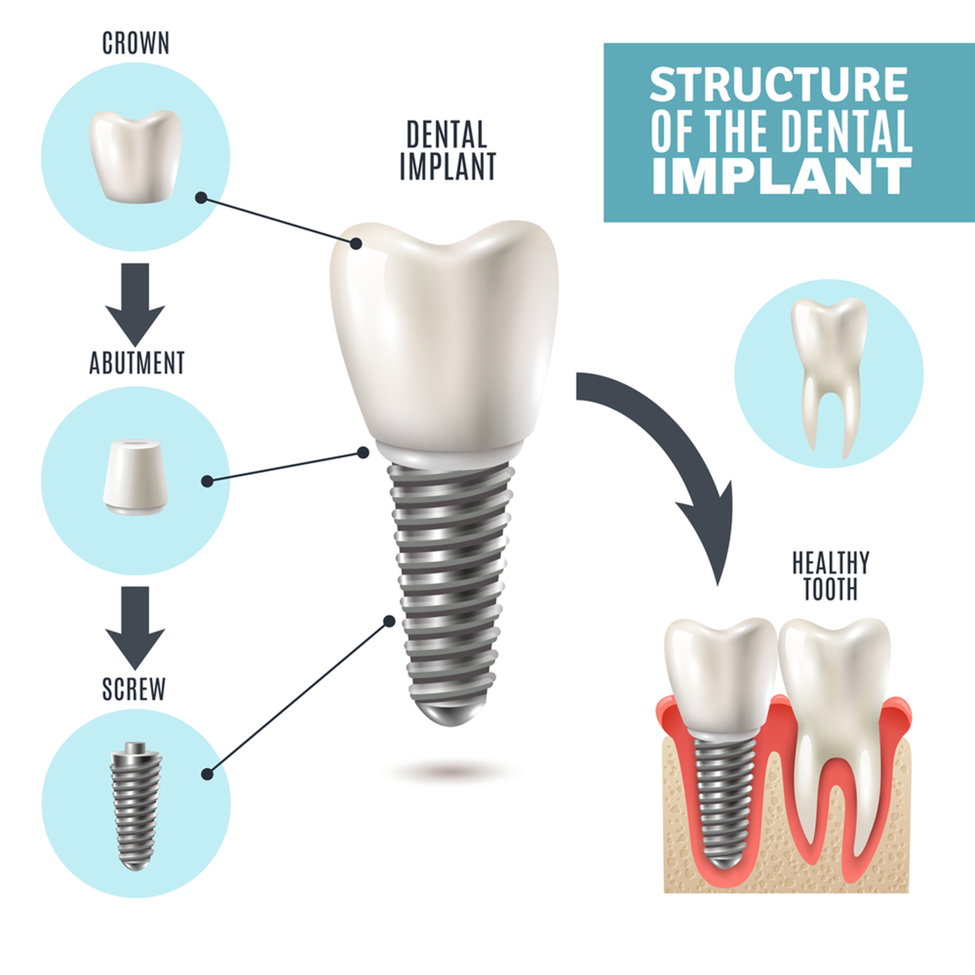 dental implants in Brampton