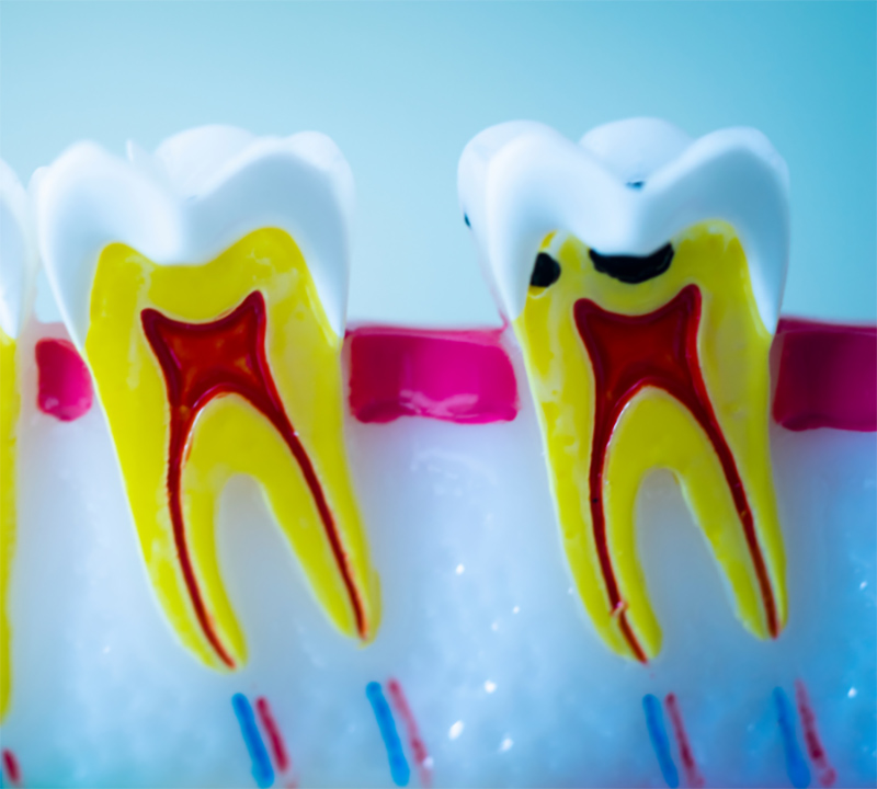 root canal treatment in Brampton